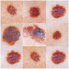 melanoma